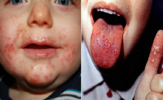 Фото энтеровирусной инфекции у детей