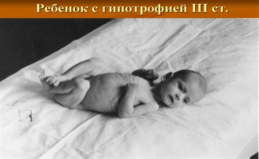 Гипотрофия у новорожденных детей