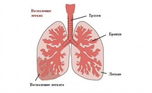 Хроническая пневмония в детском возрасте