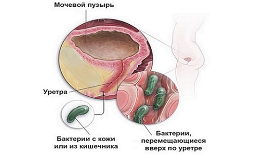 Инфекция мочеполовой системы у грудничка