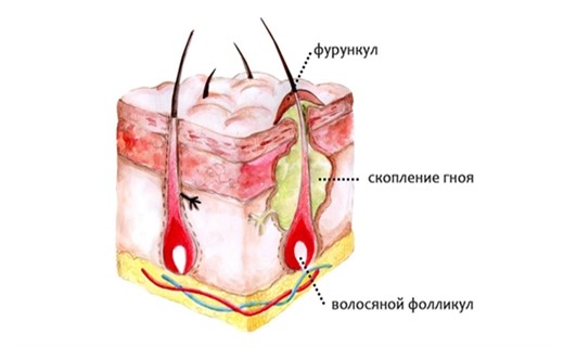 Чирей у ребенка фото