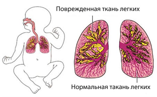 Фото пневмонии у детей