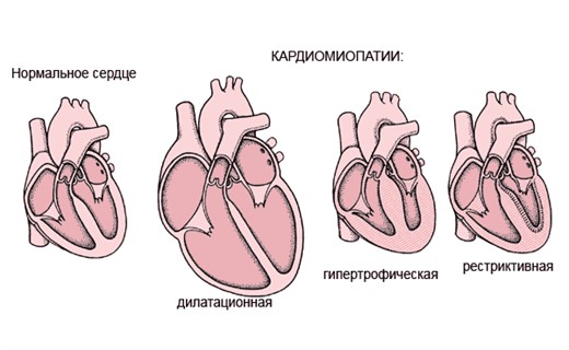 Сердечная кардиопатия