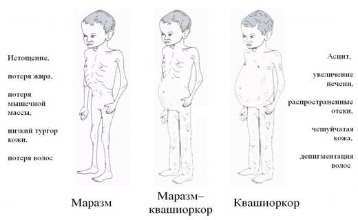 Синдром квашиоркора