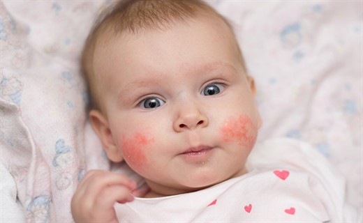 Пищевая аллергия на лице у детей
