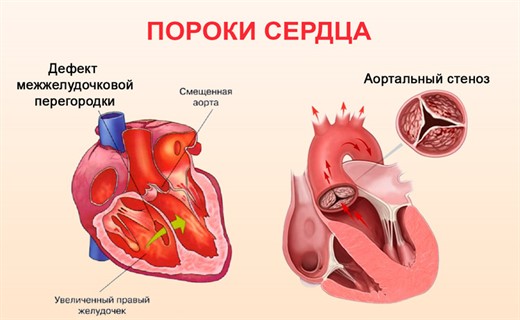 Заболевание порок сердца