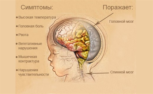 Внутриутробный менингит у новорожденных