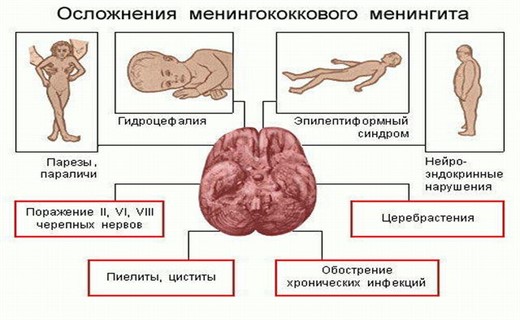 Менингококковый гнойный менингит