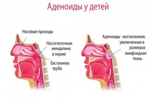 Аденоиды носоглотки