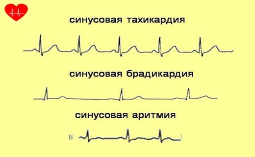 Нарушение ритма сердечных сокращений