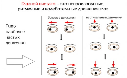 Глазной нистагм