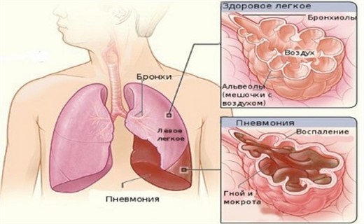 Клиническая пневмония у детей