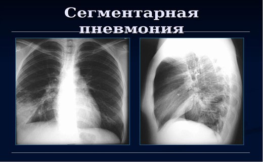 Острая сегментарная пневмония