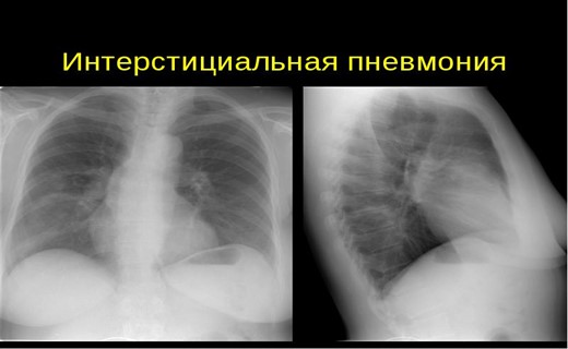 Острая интерстициальная пневмония