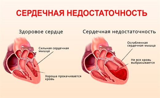 Острая сердечная недостаточность развитие