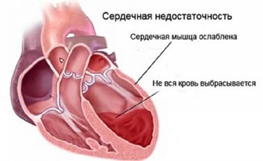 Острая сердечная недостаточность клиника