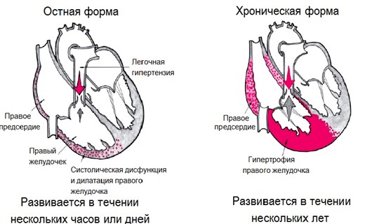 Заболевание легочное сердце