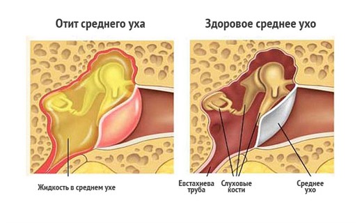 Острый двусторонний средний отит 