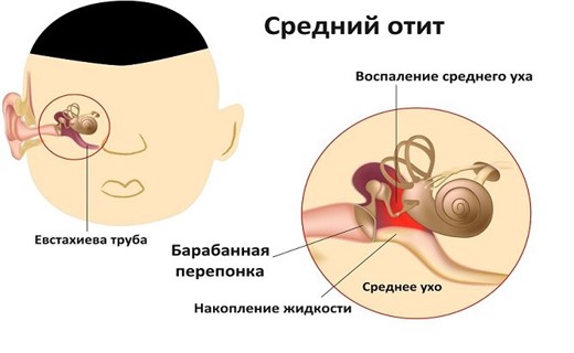 Особенности течения острого среднего отита