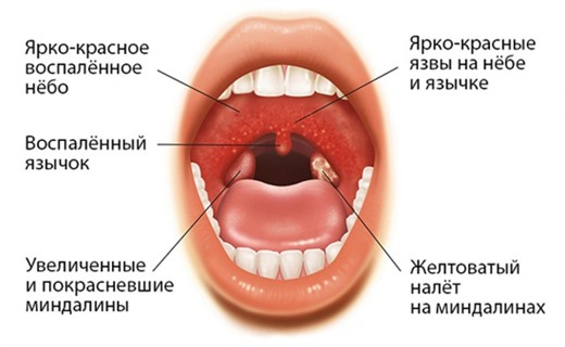 Фото лакунарной ангины