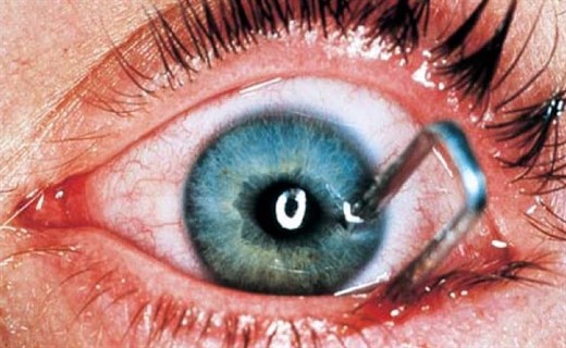 Травма глаза проникающее ранение