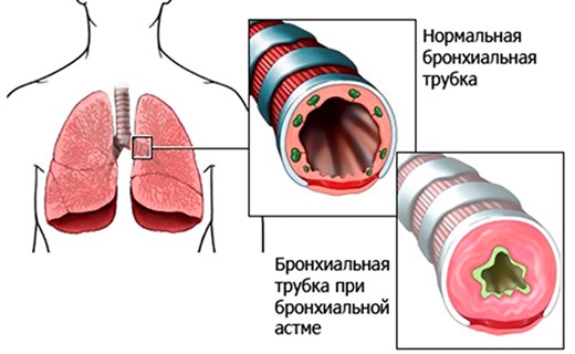 Приступ астмы у ребенка