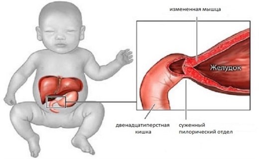 Cиндром срыгивания