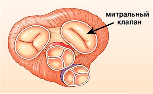 Пролапс митрального клапана сердца