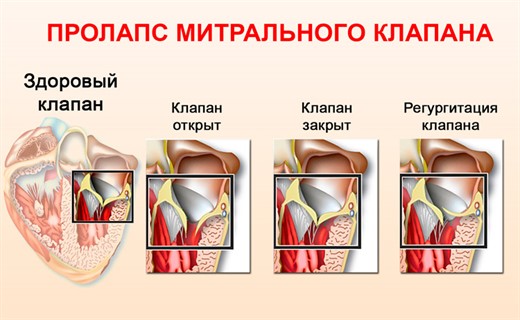 Пролапс створок митрального клапана