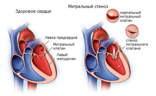 Пролапс передней створки митрального клапана