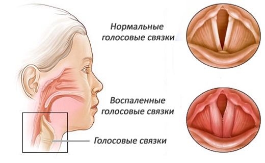 Респираторно синцитиальная инфекция клиника