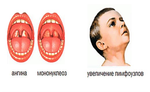 Фото инфекционного мононуклеоза