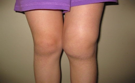 Фото артрита коленного сустава