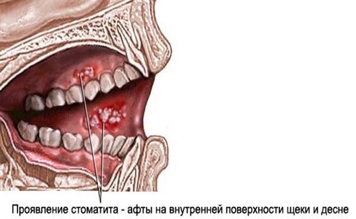 Могут при стоматите у ребенка кровить десна Могут при стоматите у ребенка кровить десна