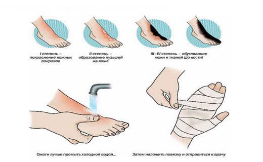 Термические повреждения ожоги