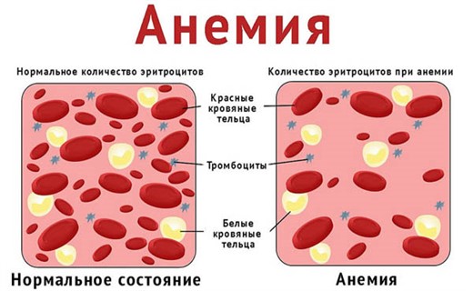 Виды анемии по анализу