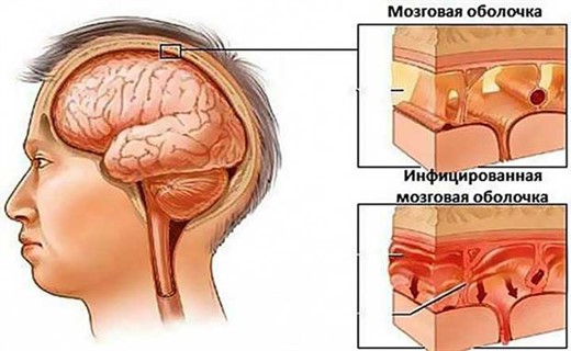 Как выглядит менингит