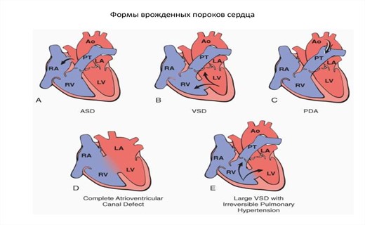 Особенности врожденных пороков сердца