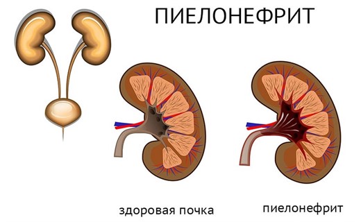 Заболевание почек пиелонефрит