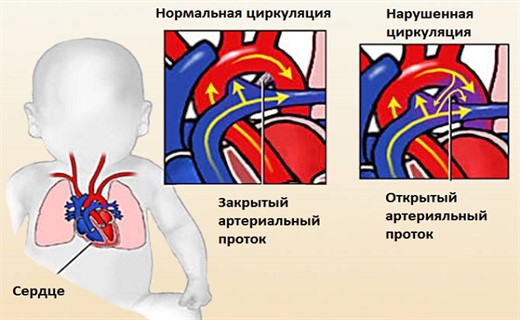 Нарушение сердечно сосудистой системы заболевания