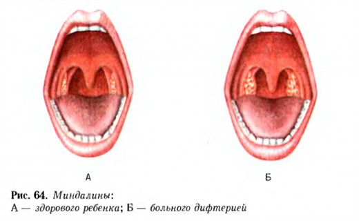 Дифтерия гортани у детей