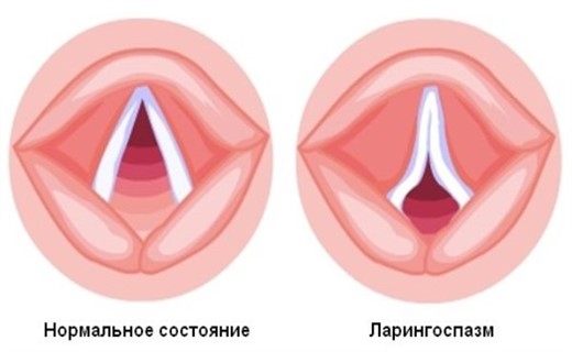 Ларингоспазм у детей