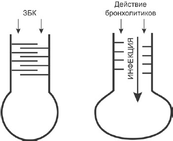 Защитная бронхоконстрикция при бронхиальной астме