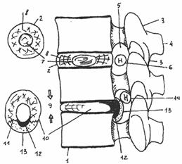 Окостенение позвоночника при грыжах