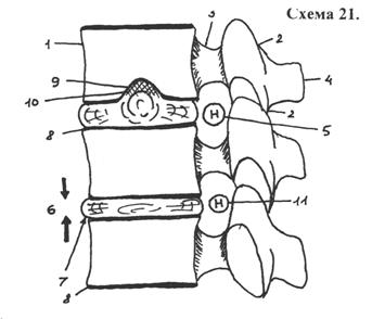 Окостенение позвоночника при грыжах thumbnail