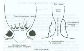 Акупунктура при лечении геморроя