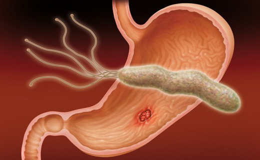 Лечение helicobacter pylori при язве желудка thumbnail