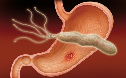 Лечении язвы желудка от хеликобактера