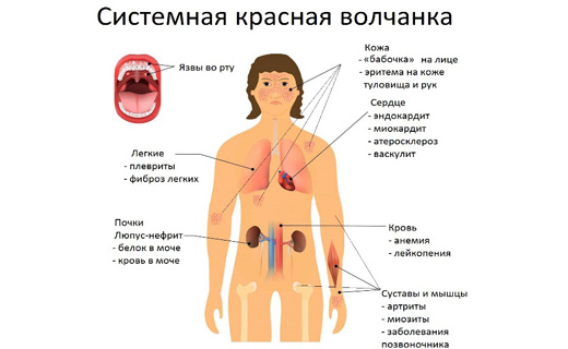 системная красная волчанка