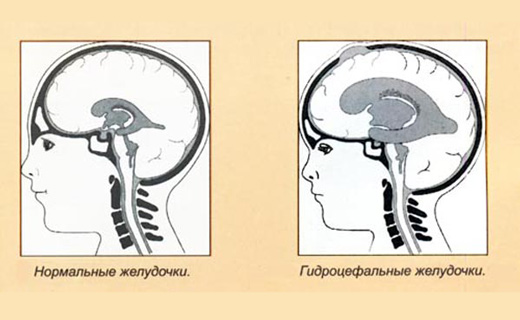 Лечение гидроцефалии мозга народными средствами у взрослых thumbnail